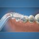 Capete ortodontice pentru dusul bucal, 2 bucati, OD-100, Waterpik 498542